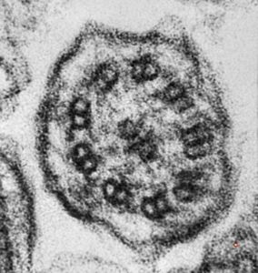 F,5y. | immotile cilia syndrome - nasal mucosa